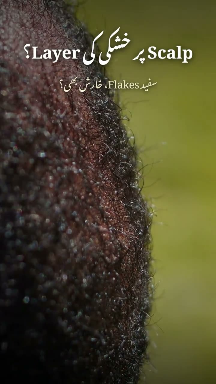 Scalp Ki Khushki 1 Week Mein Theek — Khan Herbals Shampoo